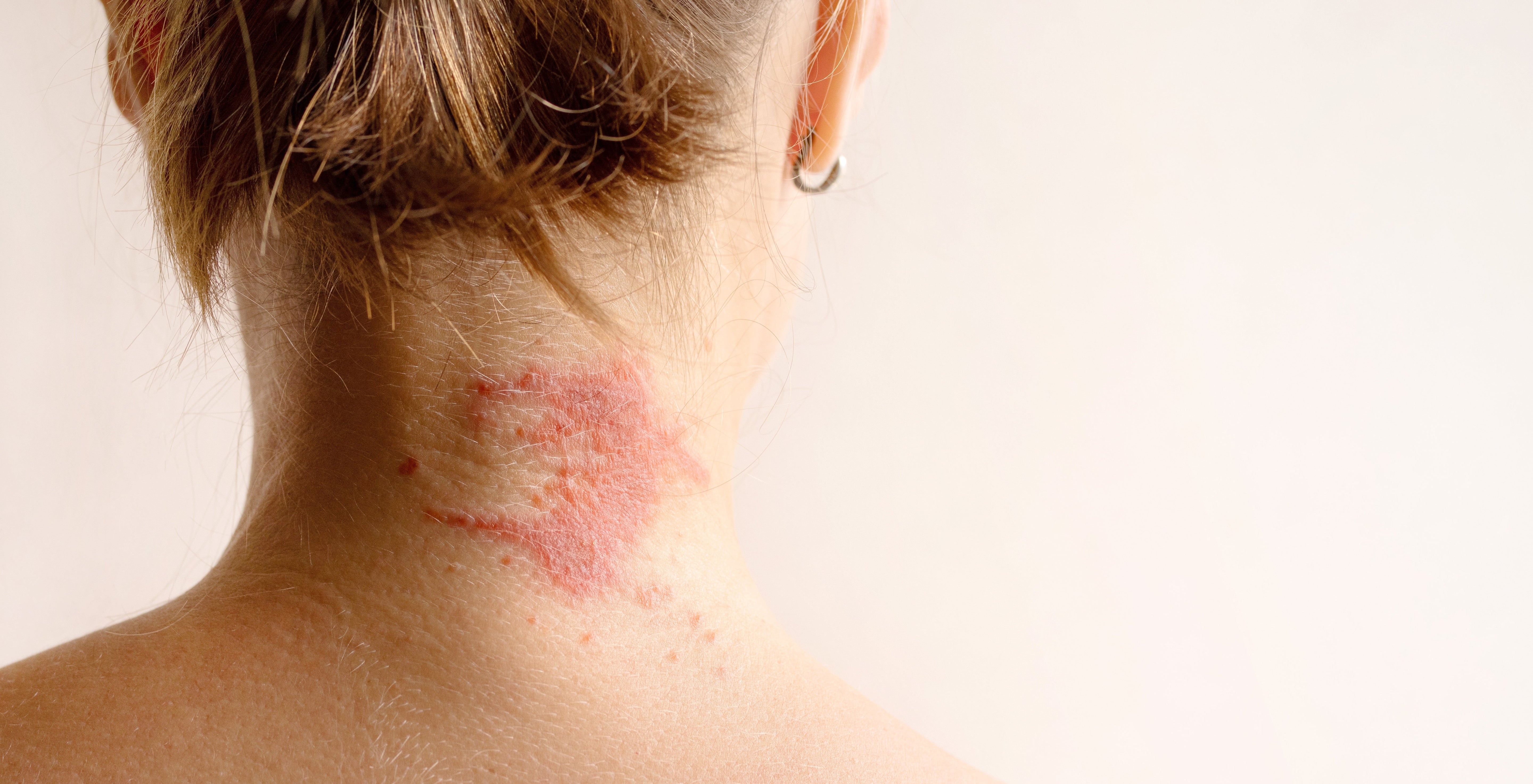 Manifestation of atopic dermatitis as a red itchy spot on a woman’s neck by isavira