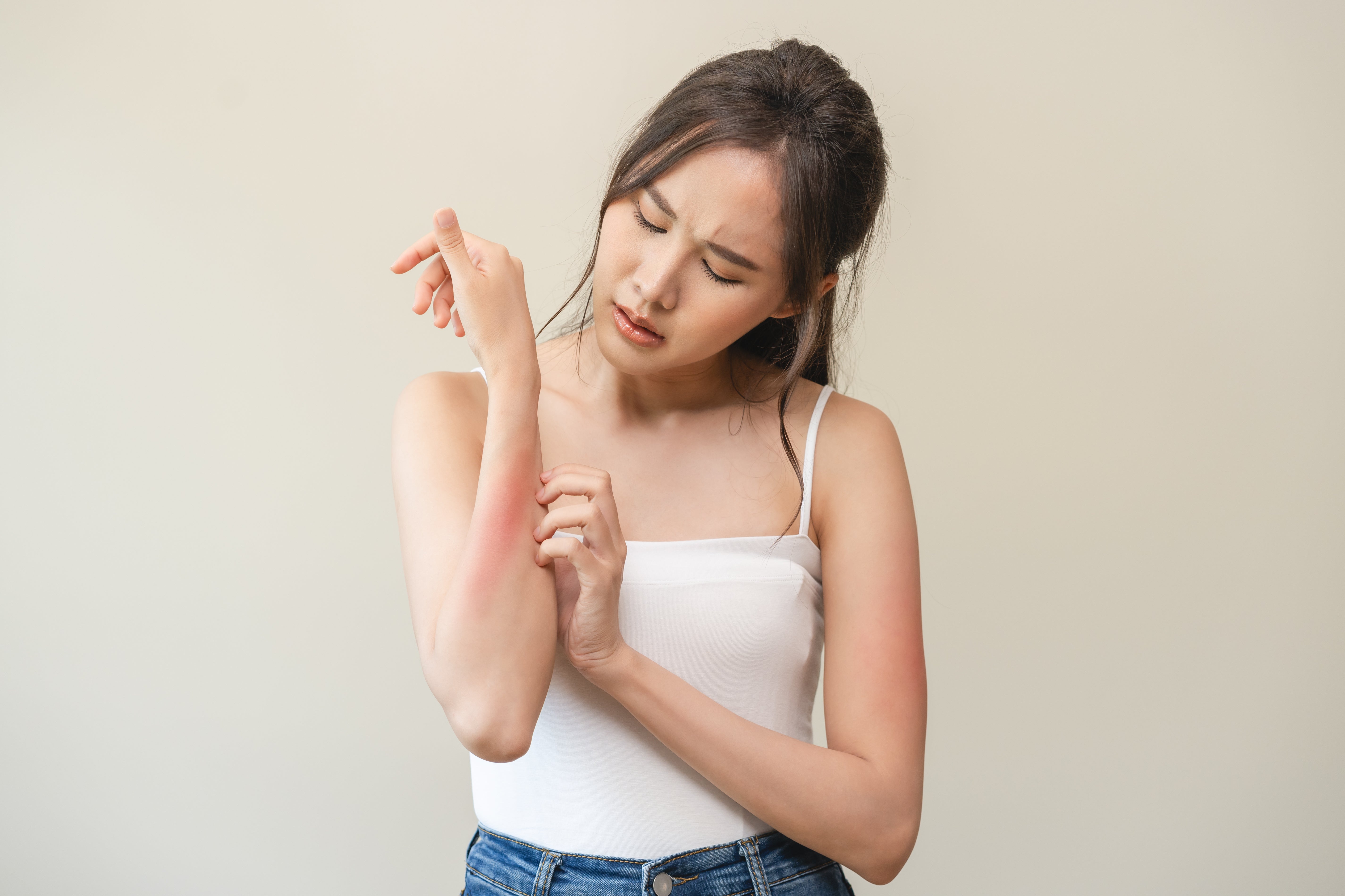 Young woman reaction from rash on her arm, hand in scratching itchy red spot by Pormezz