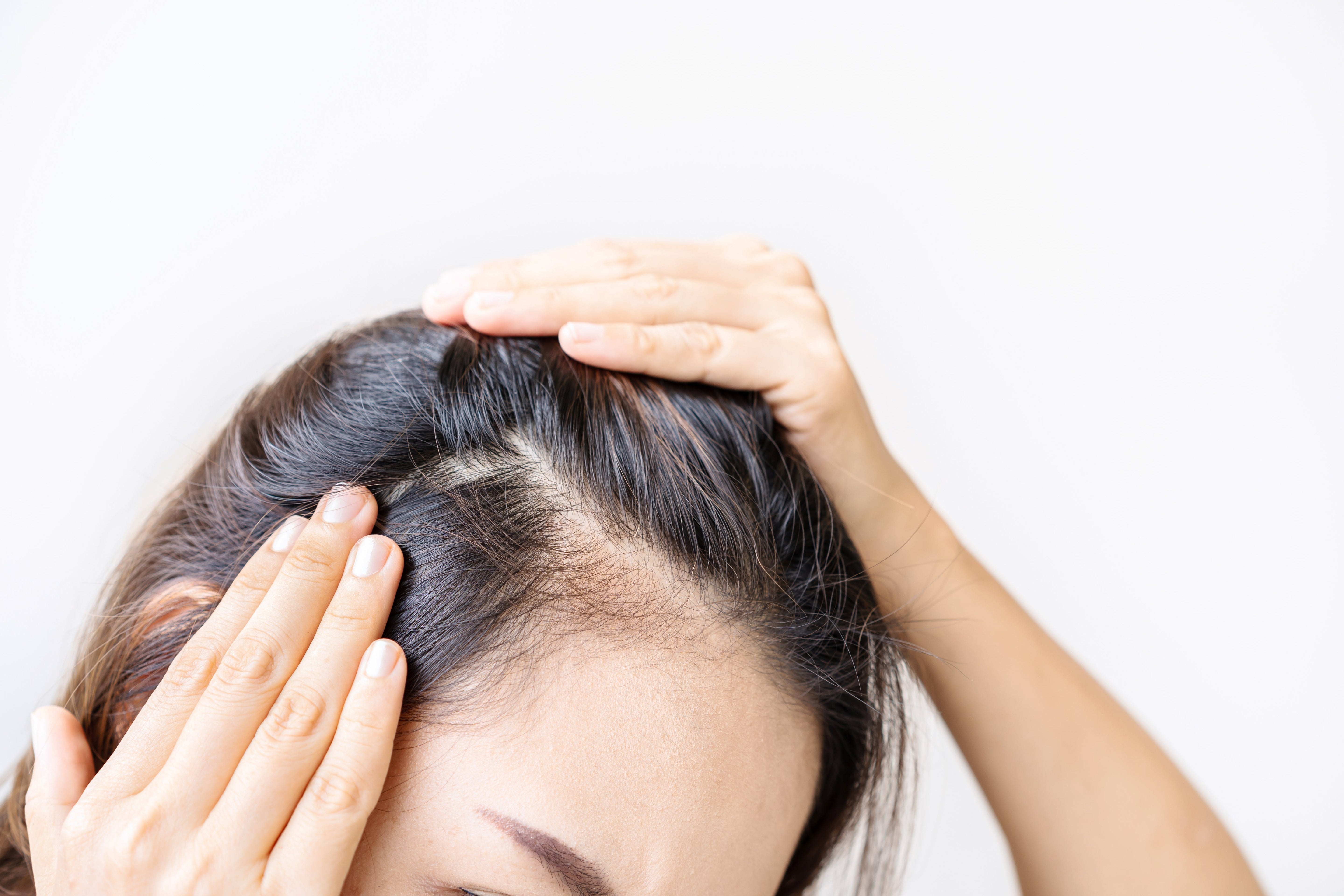 Young women worried about hair loss problems by Kittiphan