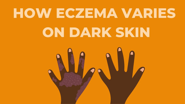Eczema on dark skin