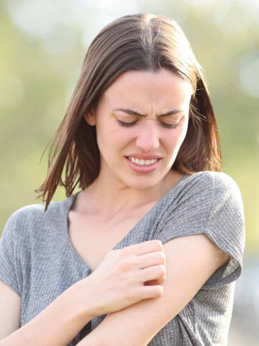 Eczema